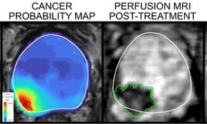 Hình MRI nơi có tế bào ung thư được lập bản đồ bằng phần mềm iQuest của Avenda Healt