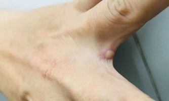 Đắk Lắk có ca nghi mắc đậu mùa khỉ đi du lịch từ nước ngoài về 