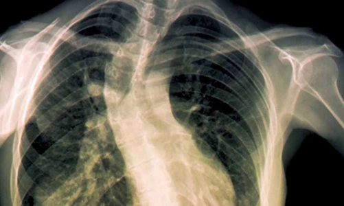 Thoát khỏi nguy cơ liệt hai chi dưới nhờ phương pháp nút mạch