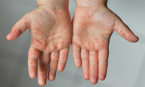 Bệnh tay chân miệng tăng báo động ở TP.HCM, 2 biến chứng phụ huynh cần lưu ý