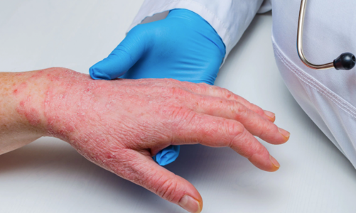 Giám sát chặt cửa khẩu phát hiện ca nghi ngờ bệnh đậu mùa khỉ