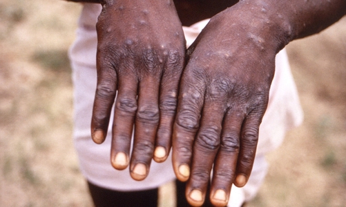 Nguy cơ đậu mùa khỉ xâm nhập, Bộ Y tế khuyến cáo biện pháp phòng bệnh