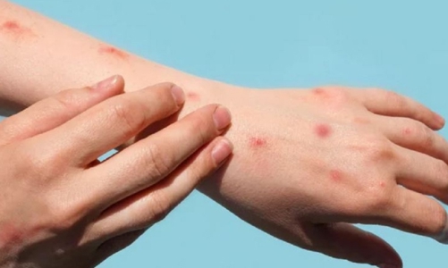 Bộ Y tế họp khẩn, lên phương án ứng phó với bệnh đậu mùa khỉ xâm nhập 