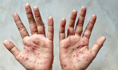 Bộ Y tế hướng dẫn chẩn đoán, điều trị bệnh đậu mùa khỉ