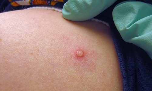 Ca bệnh đậu mùa khỉ đầu tiên tại Việt Nam lây từ nước ngoài 