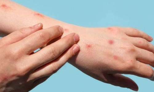 TP. HCM ghi nhận ca bệnh đậu mùa khỉ đầu tiên 