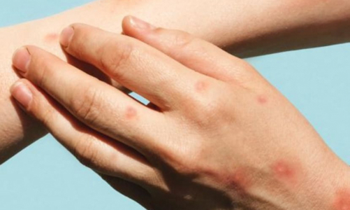 Có ca bệnh đậu mùa khỉ đầu tiên, Việt Nam chuẩn bị kịch bản ứng phó ra sao?