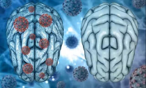 Covid-19 có thể gây viêm não tương tự bệnh Parkinson