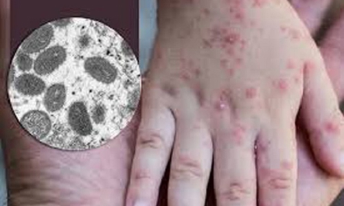 Đậu mùa khỉ được xếp vào bệnh truyền nhiễm nhóm B 