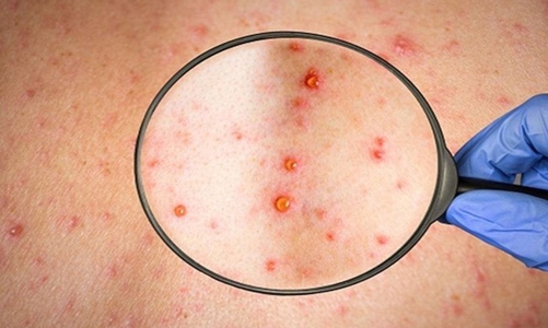 Chuyên gia: Nguồn lây bệnh đậu mùa khỉ đang lưu hành trong cộng đồng