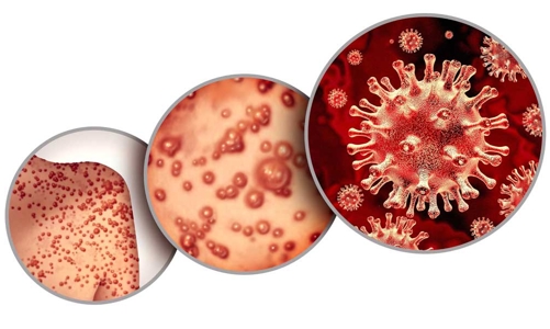 TP.HCM ghi nhận thêm 1 trường hợp mắc bệnh đậu mùa khỉ