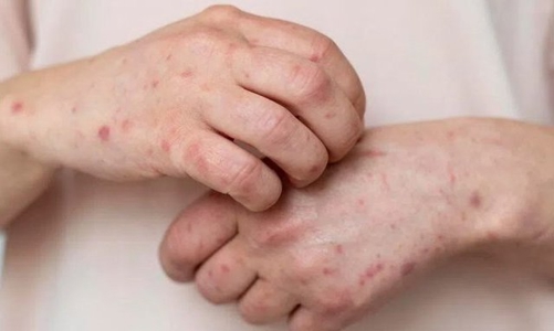 Việt Nam ghi nhận ca tử vong đầu tiên liên quan bệnh đậu mùa khỉ 