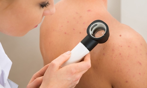 Những yếu tố nguy cơ nào dẫn đến ung thư da?