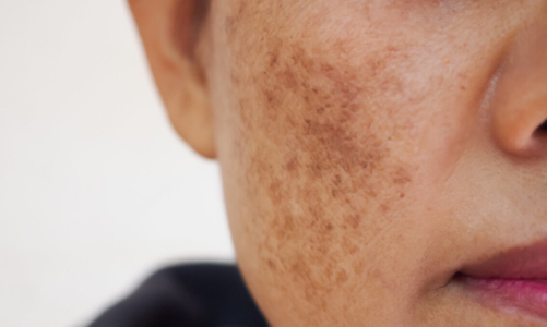 Chọn hoạt chất hiệu quả nhất để giải quyết nám da