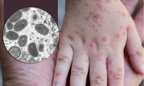 Bộ Y tế yêu cầu tăng cường giám sát bệnh đậu mùa khỉ 