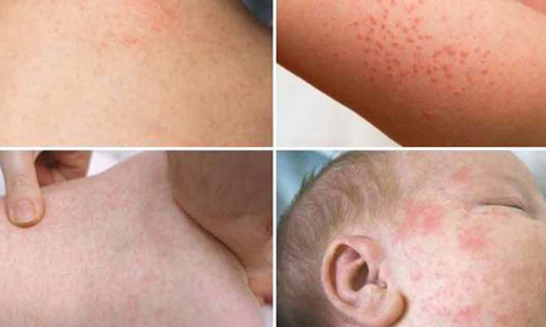 Ca mắc sởi tăng nhanh, TP.HCM tăng cường kiểm soát lây nhiễm sởi trong cộng đồng