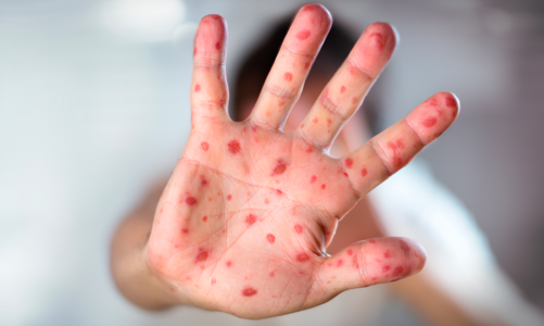 Bộ Y tế khuyến cáo các biện pháp phòng bệnh sởi