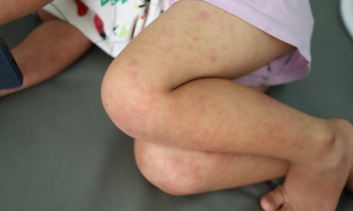 TP.HCM lo thiếu thuốc điều trị khi dịch sởi tiếp tục gia tăng