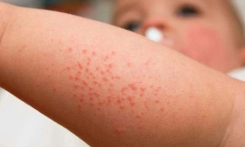 Bộ Y tế thông tin về việc hàng trăm trẻ sốt phát ban tại Quảng Nam 