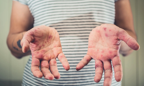 Người lớn mắc sởi dễ có biến chứng nguy hiểm