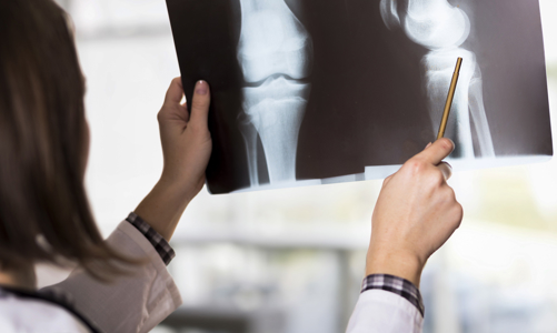 Tiến bộ y học trong bảo vệ xương khớp người cao tuổi