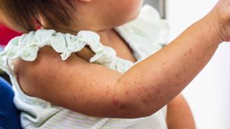 Gia tăng nguy cơ mắc bệnh truyền nhiễm, Bộ Y tế yêu cầu tăng cường phòng chống 
