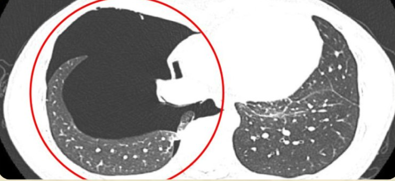 H&igrave;nh ảnh chụp CT của bệnh nh&acirc;n cho thấy tr&agrave;n kh&iacute; khoang m&agrave;ng phổi phải mức độ vừa đến nhiều. Ảnh: Bệnh viện cung cấp.