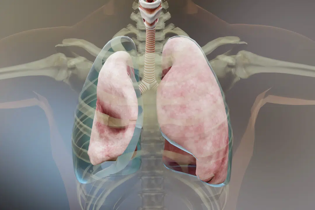 Khi&nbsp;&aacute;p lực trong lồng ngực gia tăng c&oacute; thể khiến b&oacute;ng kh&iacute; dưới m&agrave;ng phổi bị vỡ.