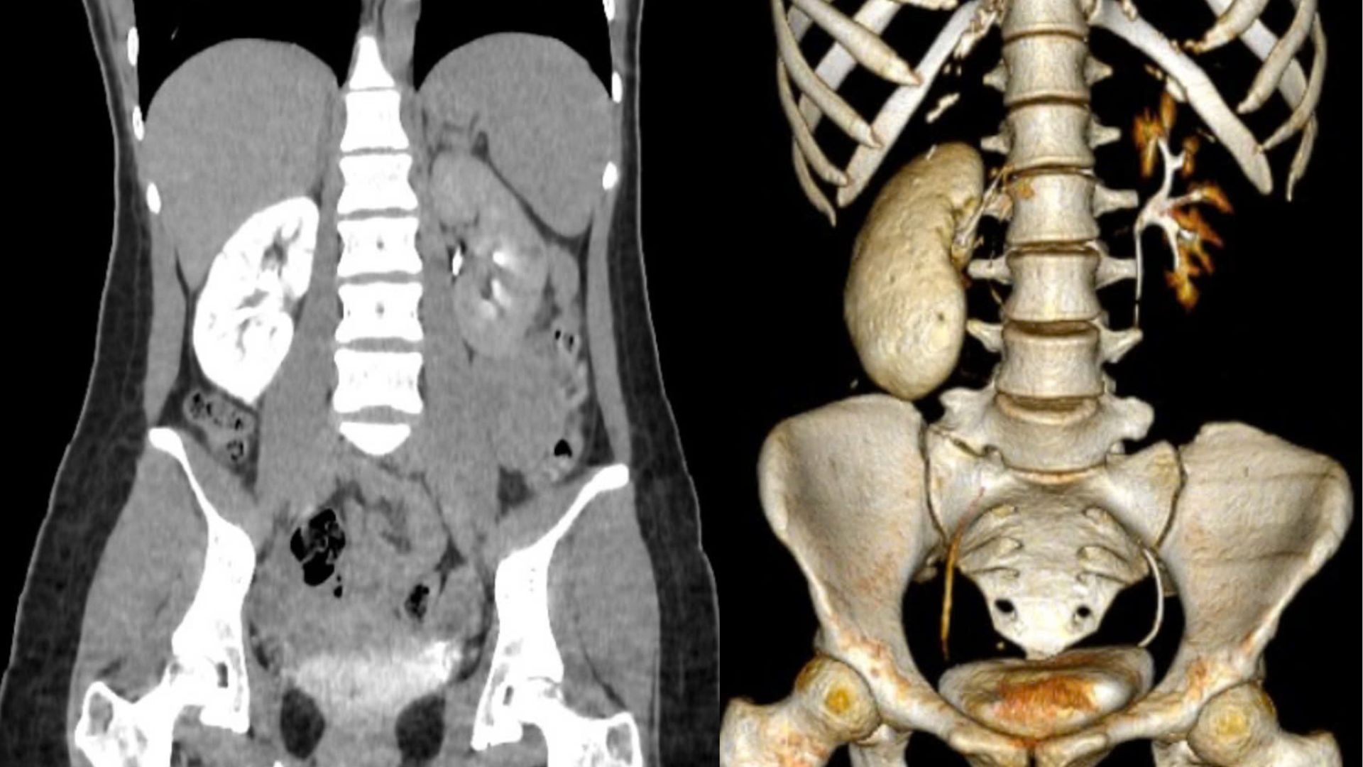 Thận bệnh nh&acirc;n 18 tuổi gần như 