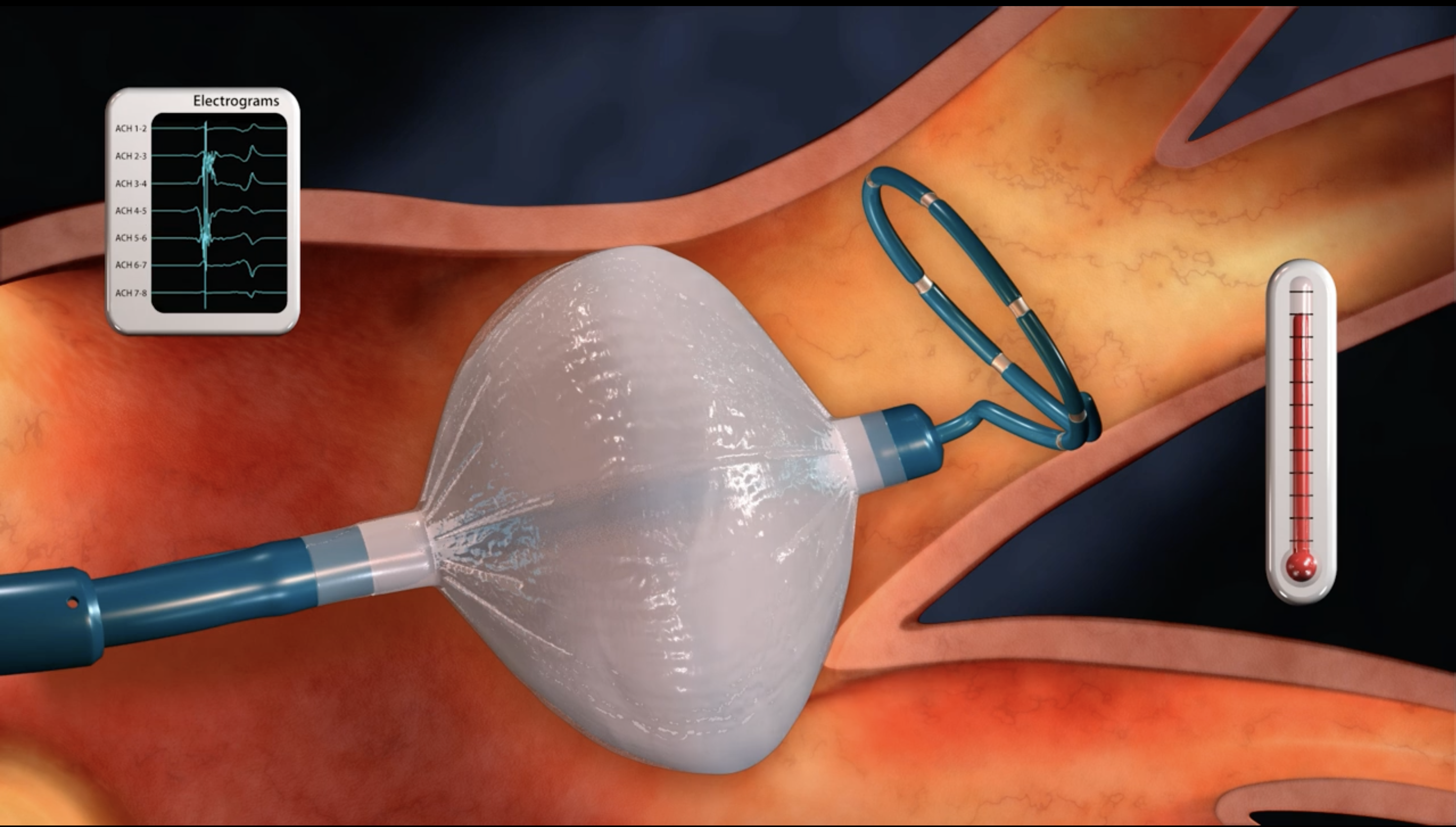 Việc c&aacute;c b&aacute;c sĩ l&agrave;m chủ c&ocirc;ng nghệ Cryo-balloon l&agrave; cơ sở để Bộ Y tế ban h&agrave;nh quy tr&igrave;nh kỹ thuật &aacute;p dụng ch&iacute;nh thức tại Việt Nam.