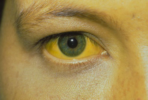 Bệnh nhân sốt vàng - Ảnh: Health.