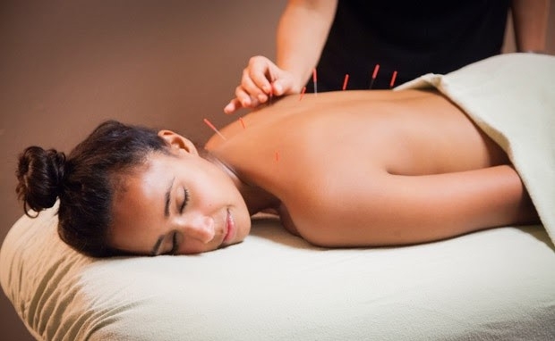 Bạn đã hiểu đúng về thuật châm cứu? - Ảnh 1.