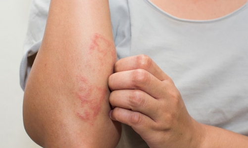 Bệnh chàm: nguyên nhân và cách điều trị