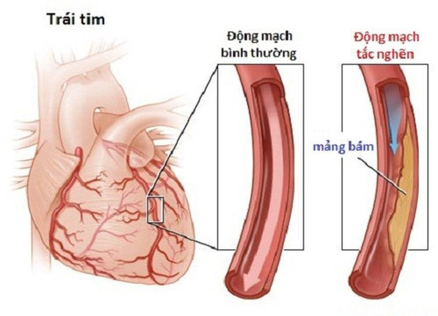 Dấu hiệu thầm lặng của tắc động mạch không nên bỏ qua - Ảnh 2.
