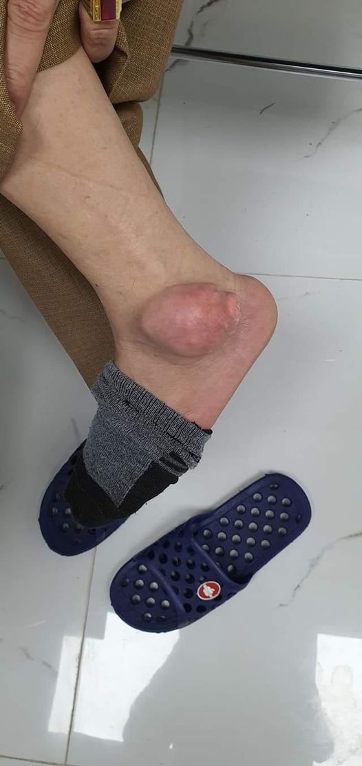 Nổi u to như quả ổi vì tự chữa Gout bằng thuốc trên mạng - Ảnh 1.