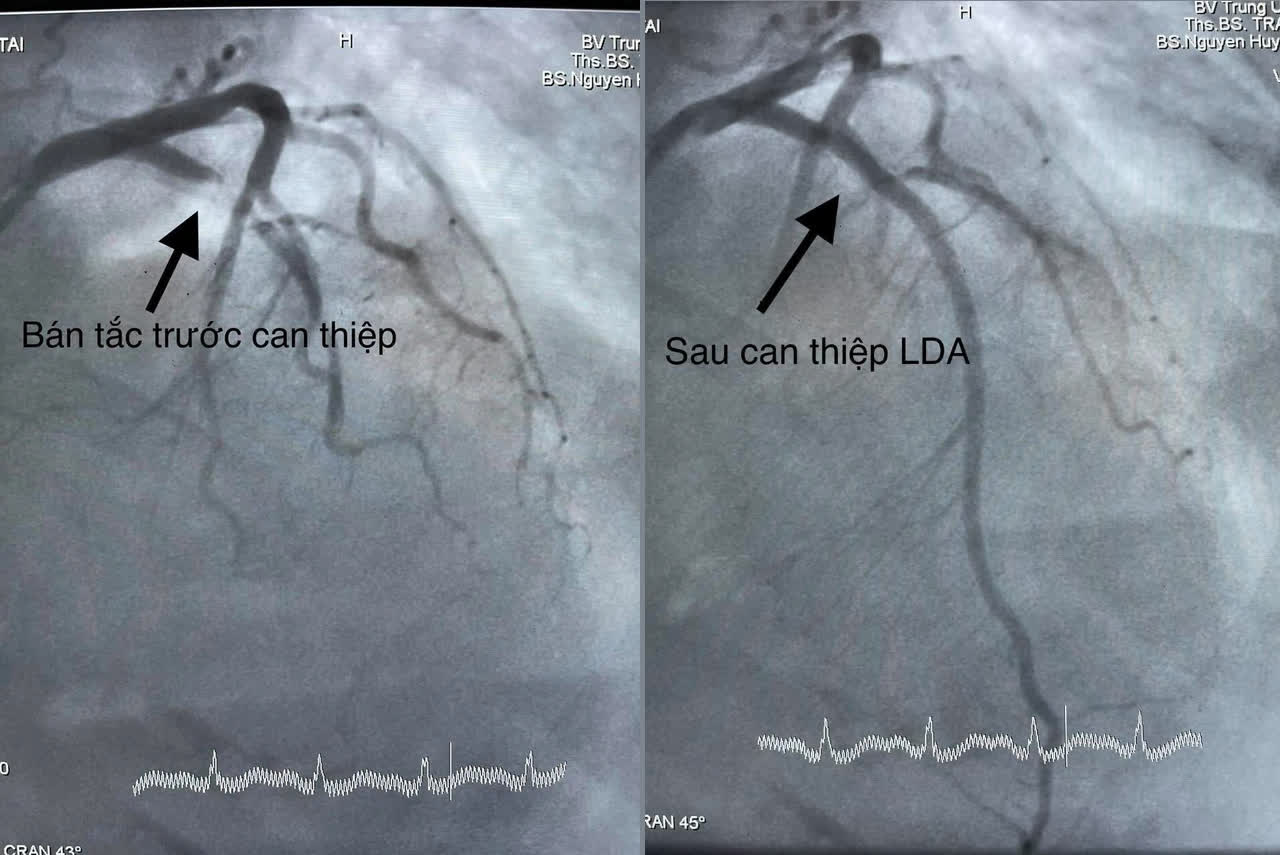 Bệnh nhân nhồi máu cơ tim cấp hồi sinh kỳ diệu - Ảnh 1.