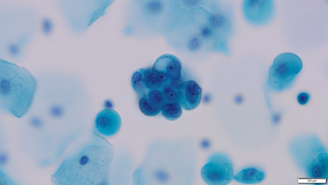 Xét nghiệm tại nhà giúp tầm soát ung thư cổ tử cung chính xác hơn 90% - Ảnh 2.