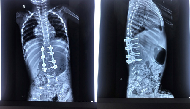 Bệnh nhi 3 tuổi chỉnh hình cột sống thành công - Ảnh 1.