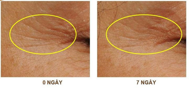 Chuyên gia Đại học Y Hà Nội giới thiệu công nghệ chống nhăn ứng dụng từ giải thưởng Nobel - Ảnh 4.