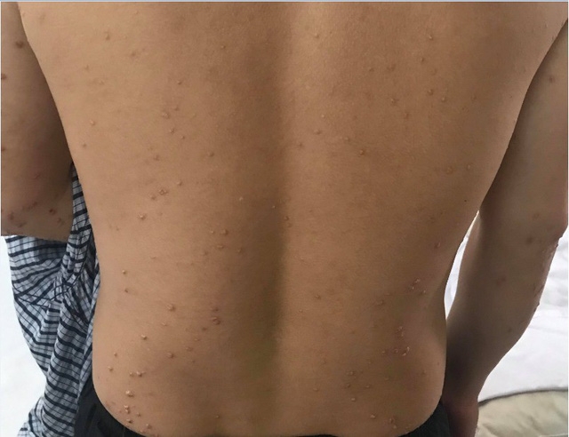 U vàng phát ban do tăng triglycerid máu - Ảnh 1.