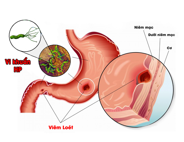 Những nguyên nhân gây đau dạ dày và mẹo trị bệnh hiệu quả - Ảnh 2.
