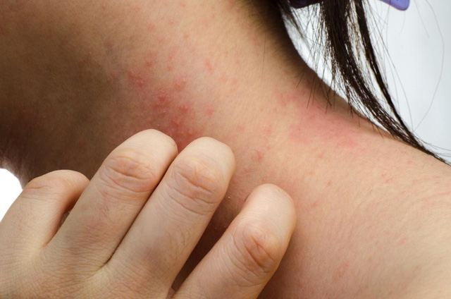 Cẩn trọng với triệu chứng dị ứng thuốc nhuộm tóc - Ảnh 1.
