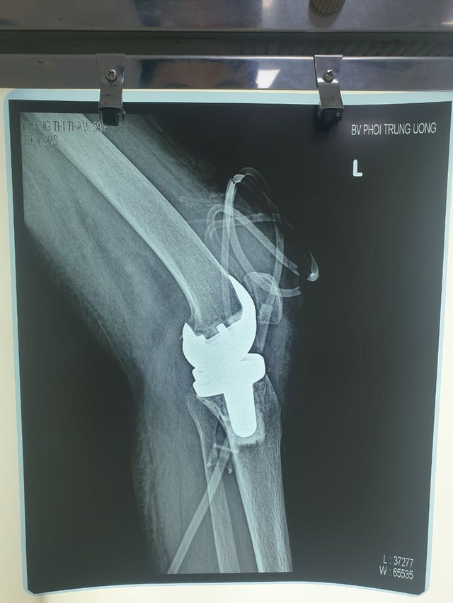 Thay khớp gối nhân tạo cho người mắc lao khớp gối - Ảnh 1.