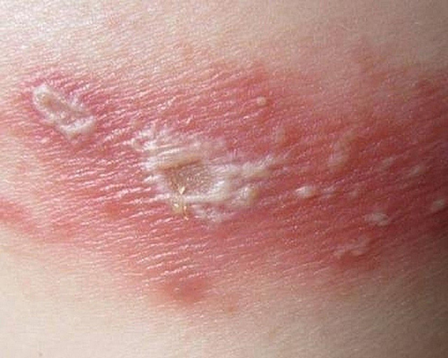 Hạn chế kiến ba khoang và cách xử lý khi bị đốt - Ảnh 1.