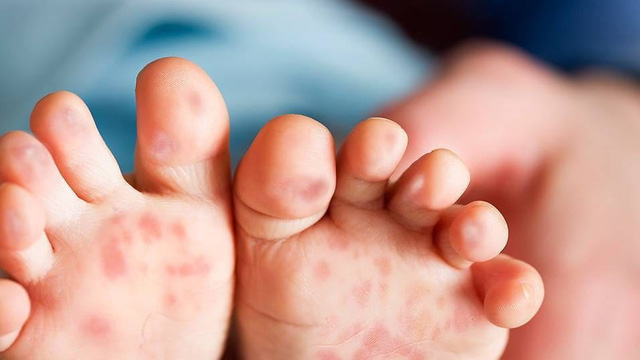 Phòng ngừa bệnh dễ mắc ở trẻ vào mùa hè - Ảnh 1.