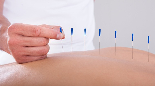 Bạn đã hiểu đúng về thuật châm cứu? - Ảnh 2.