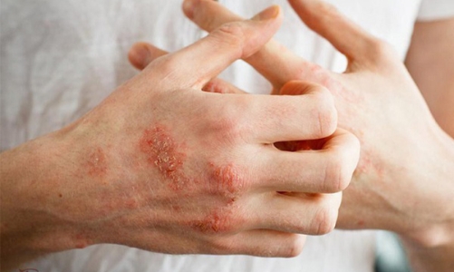 8 biện pháp tự nhiên giúp kiểm soát các triệu chứng bệnh chàm