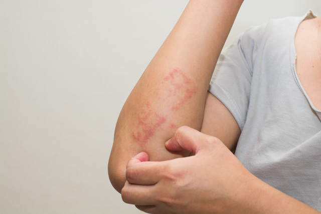 Những thủ phạm gây ngứa da mùa lạnh - Ảnh 1.