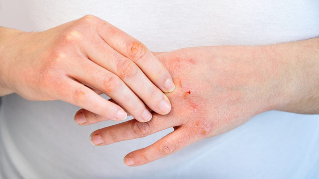 Những thủ phạm gây ngứa da mùa lạnh - Ảnh 2.