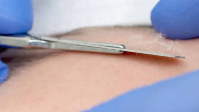 Sự thật về phương pháp Dermaplaning - Ảnh 2.